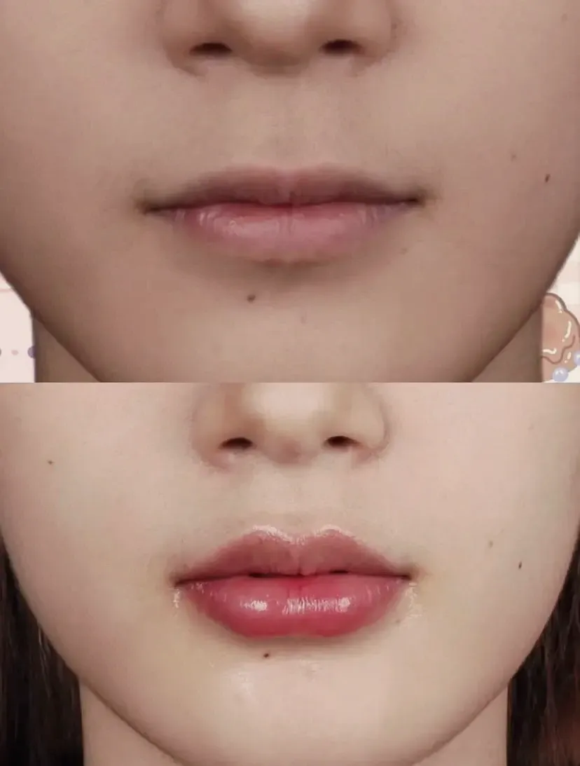 Lip filler before and after case 3 at Edition Clinic Bangkok Thonglor