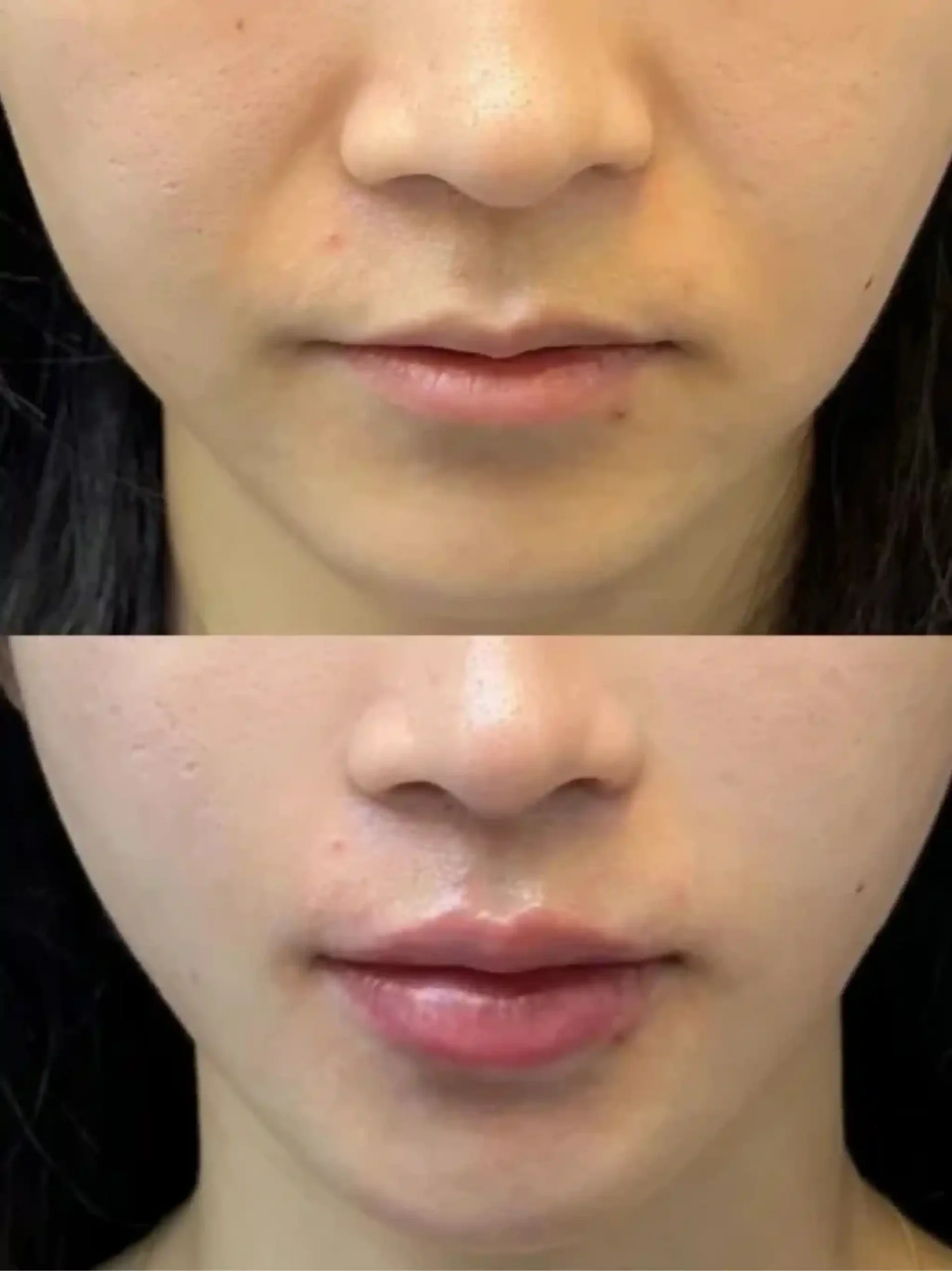 Lip filler before and after case 4 at Edition Clinic Bangkok Thonglor