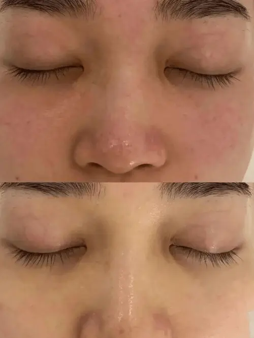 Skin rejuvenation and texture improvement results with LDM dual-frequency ultrasound at Edition Clinic Thonglor