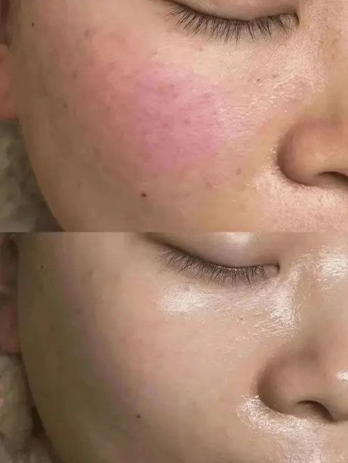 Facial redness reduction and skin tone correction before and after with LDM Water Drop Lifting at Edition Clinic Bangkok