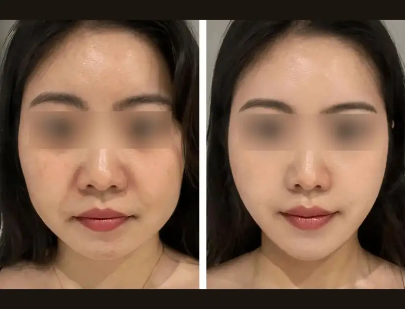 Double chin reduction results after Oligio X RF lifting at Edition Clinic Thonglor
