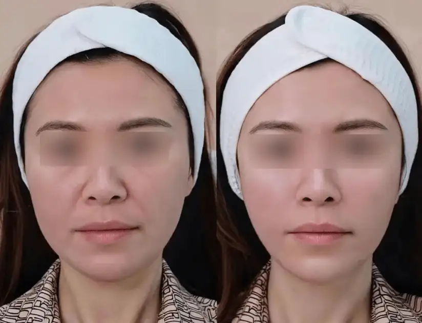 Full face lifting before and after with Oligio X Korean RF at Edition Clinic Bangkok