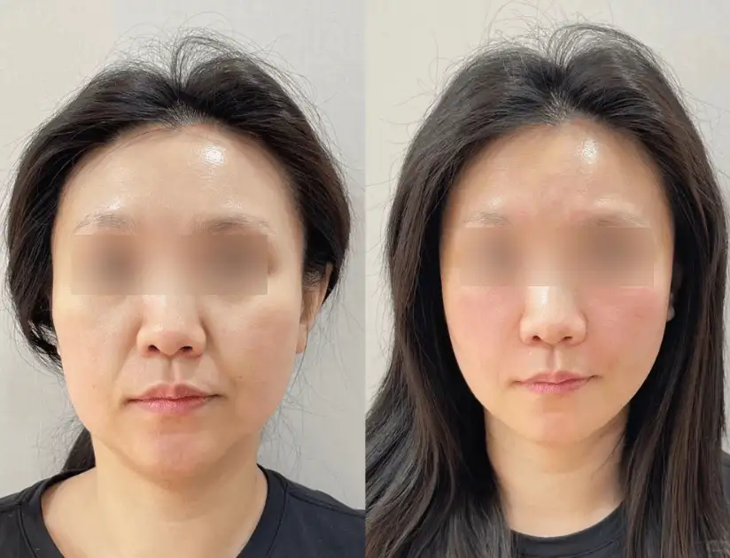 Jowl tightening before and after with Oligio X Korean RF lifting at Edition Clinic Bangkok